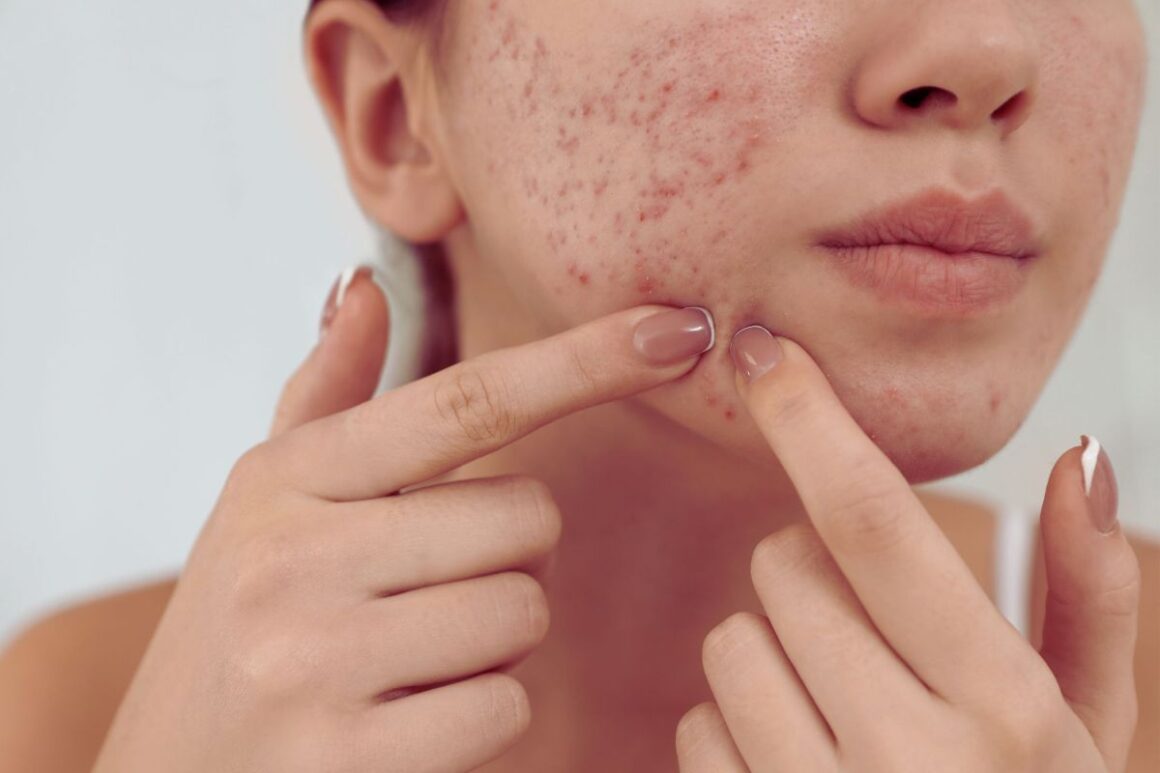 Akne kod odraslih često dolaze s borama i neujednačenim tenom. Doznajte kako ih liječiti bez kompromisa uz savjete dermatologinje.